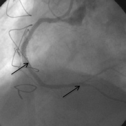 Hastanın sağ damarı tam tıkalı damarları açma yöntemi (cto) ile sol damardan yan kılcal damar