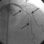 LAD damarı orta kısmında uzun, çatal iki yan damar çıkan, bir yan damarın girişinde de darlık olan kompleks darlık.