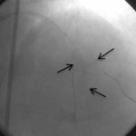 Çatallanma yapan üç damara 3 tel yerleştirilerek üç damara aynı anda müdahale ediliyor.
