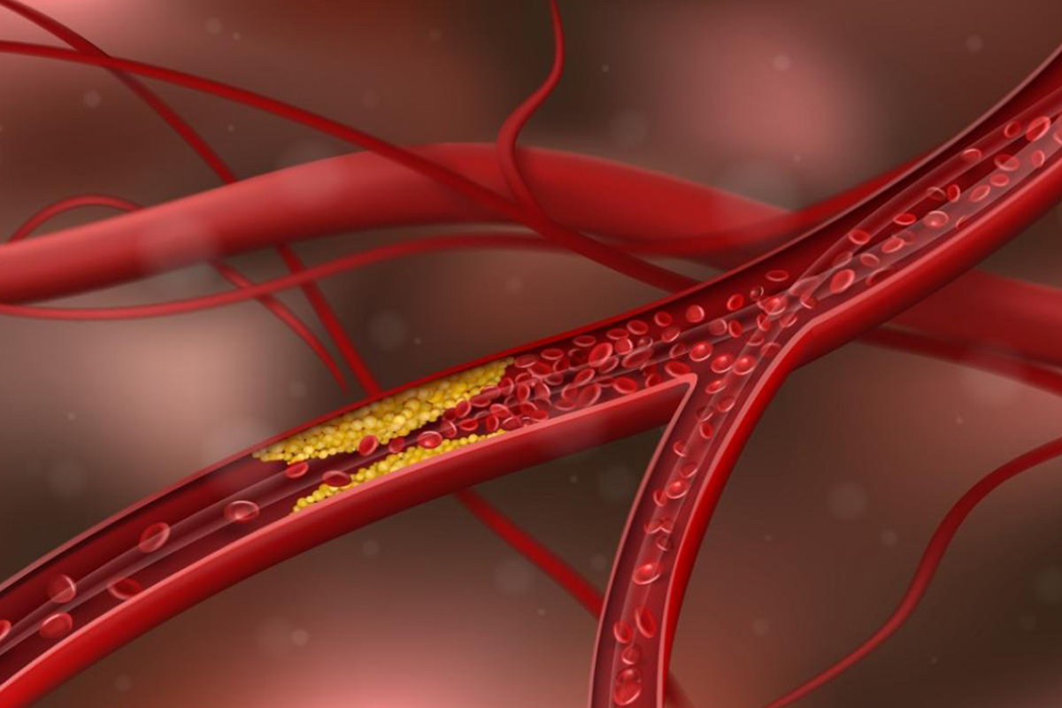 Tam Tıkalı Damarların Açılması (CTO)